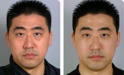 超声波去眼袋手术性价比高看得见930 超声波去眼袋手术性价比高看得见930