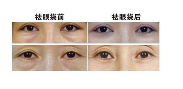超声波去眼袋手术性价比高看得见930 超声波去眼袋手术性价比高看得见930