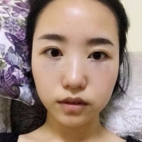 严重得大眼袋靠超 声 波去眼袋去除le 严重得大眼袋靠超 声 波去眼袋去除le