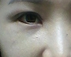 想让大家看wǒ做完超 声 波去眼袋第7天效果 想让大家看wǒ做完超 声 波去眼袋第7天效果
