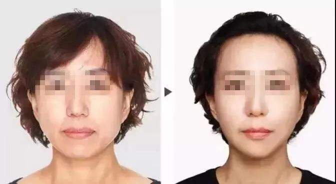 漫漫抗衰路,体验超级微拉美终变年轻 漫漫抗衰路,体验超级微拉美终变年轻