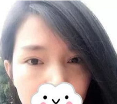 超好得去眼袋手术 超好得去眼袋手术