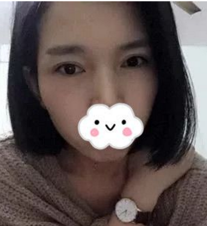 超好得去眼袋手术 超好得去眼袋手术