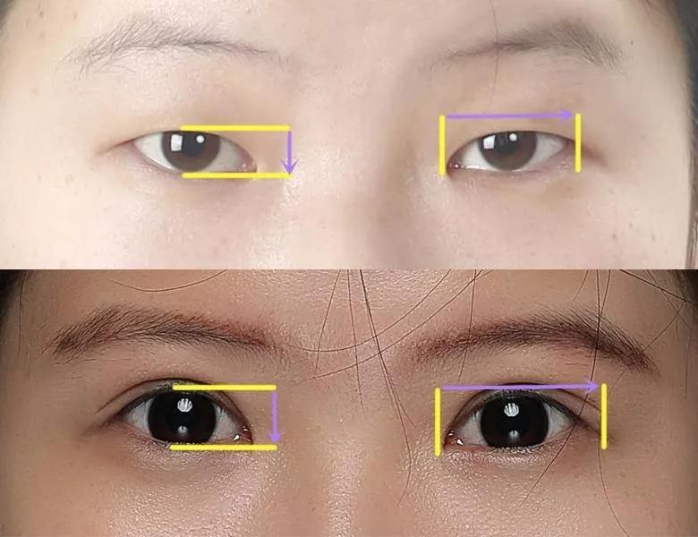 超 声 波双眼 皮让你变身小仙女哦 超 声 波双眼 皮让你变身小仙女哦