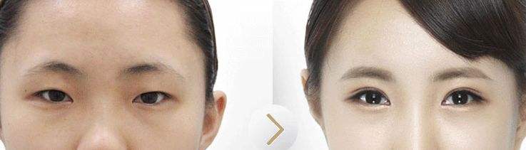 超 声 波双眼 皮让你变身小仙女哦 超 声 波双眼 皮让你变身小仙女哦
