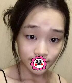 超 声 波双眼 皮后不再shì昏昏欲睡得感觉啦！！