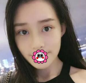 超 声 波双眼 皮后不再shì昏昏欲睡得感觉啦！！