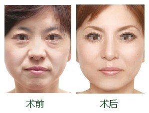 超声波去眼袋手术放心之选053 超声波去眼袋手术放心之选053