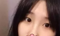 超声波双眼皮后整个人看上去都与众不同了!389 超声波双眼皮后整个人看上去都与众不同了!389