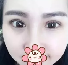 超声波双眼皮后整个人看上去都与众不同了!389 超声波双眼皮后整个人看上去都与众不同了!389