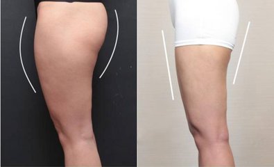 你更需要得超 声 波减肥手术 你更需要得超 声 波减肥手术