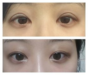 微创双眼 皮手术到底存在不存在呢? 微创双眼 皮手术到底存在不存在呢?