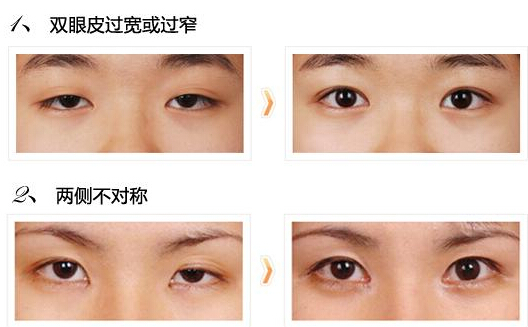 微创双眼 皮手术到底存在不存在呢? 微创双眼 皮手术到底存在不存在呢?