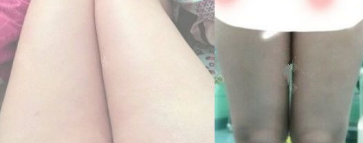 展示我超声波减肥瘦大腿恢复过程及效果图514 展示我超声波减肥瘦大腿恢复过程及效果图514