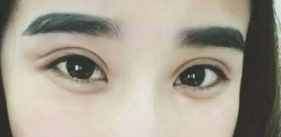 感恩,超声波双眼皮把我眼睛变漂亮了407 感恩,超声波双眼皮把我眼睛变漂亮了407