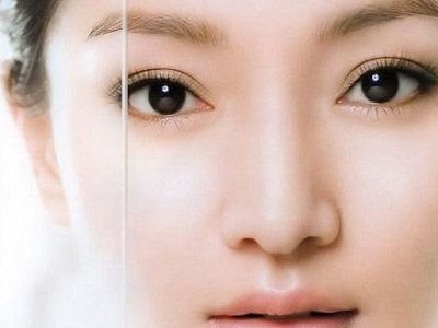 感恩,超声波双眼皮把我眼睛变漂亮了407 感恩,超声波双眼皮把我眼睛变漂亮了407