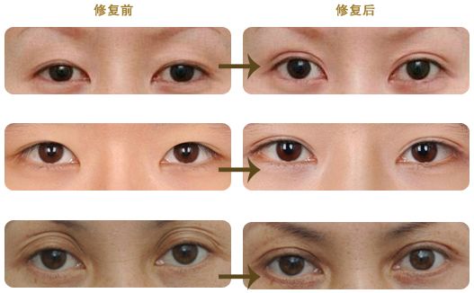 感恩,超声波双眼皮把我眼睛变漂亮了407 感恩,超声波双眼皮把我眼睛变漂亮了407