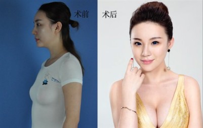 超声波自体脂肪丰胸,成就自己的梦想791 超声波自体脂肪丰胸,成就自己的梦想791