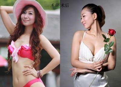 超声波自体脂肪丰胸,成就自己的梦想791 超声波自体脂肪丰胸,成就自己的梦想791
