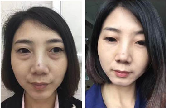 在超雅去了眼袋太高兴了,超声波去眼袋手术349 在超雅去了眼袋太高兴了,超声波去眼袋手术349