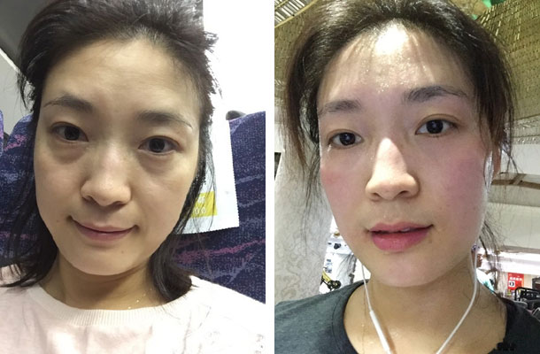 在超雅去了眼袋太高兴了,超声波去眼袋手术349 在超雅去了眼袋太高兴了,超声波去眼袋手术349