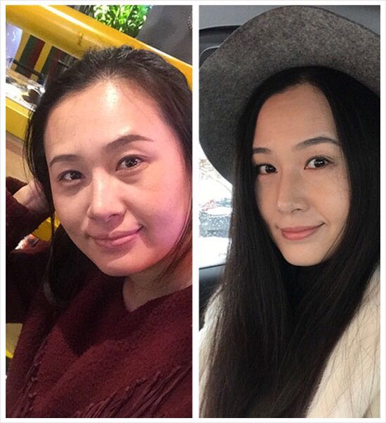 在超雅去了眼袋太高兴了,超声波去眼袋手术349 在超雅去了眼袋太高兴了,超声波去眼袋手术349