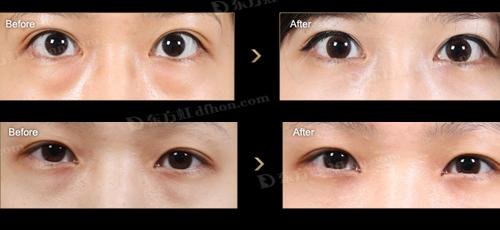 超 声 波去眼袋手术方方面面都做得好 超 声 波去眼袋手术方方面面都做得好
