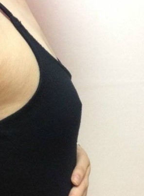 超声波自体脂肪丰胸后让我有了女人的骄傲665 超声波自体脂肪丰胸后让我有了女人的骄傲665