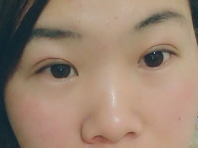 超声波双眼皮,有了我梦想中的双眼皮711 超声波双眼皮,有了我梦想中的双眼皮711