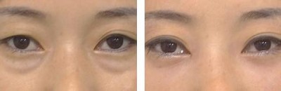 去掉眼袋,展现自己的光彩153 去掉眼袋,展现自己的光彩153