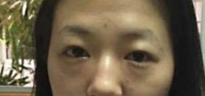 超声波去眼袋,让忙碌的你不受眼袋困扰781 超声波去眼袋,让忙碌的你不受眼袋困扰781