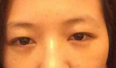 超声波去眼袋,让忙碌的你不受眼袋困扰781 超声波去眼袋,让忙碌的你不受眼袋困扰781