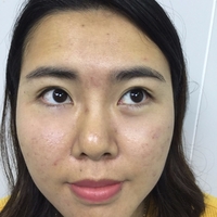 超 声 波去眼袋让wǒ气质更出众
