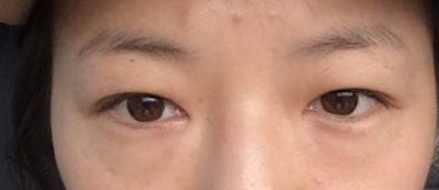 超声波去眼袋,还给你应有的青春499 超声波去眼袋,还给你应有的青春499