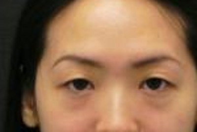 超声波去眼袋,跟老气的眼袋说拜拜171 超声波去眼袋,跟老气的眼袋说拜拜171