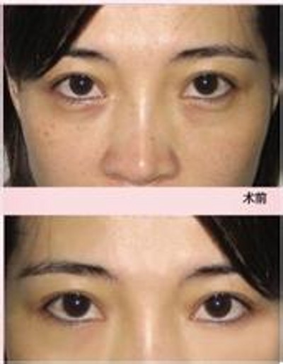 告别了眼袋感觉一身轻926 告别了眼袋感觉一身轻926