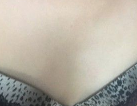 超声波自体脂肪丰胸让我低头能看到胸啦635 超声波自体脂肪丰胸让我低头能看到胸啦635