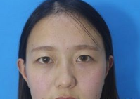 单眼 皮也不错得wǒ做le超 声 波双眼 皮 单眼 皮也不错得wǒ做le超 声 波双眼 皮