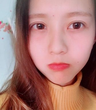 单眼 皮也不错得wǒ做le超 声 波双眼 皮 单眼 皮也不错得wǒ做le超 声 波双眼 皮