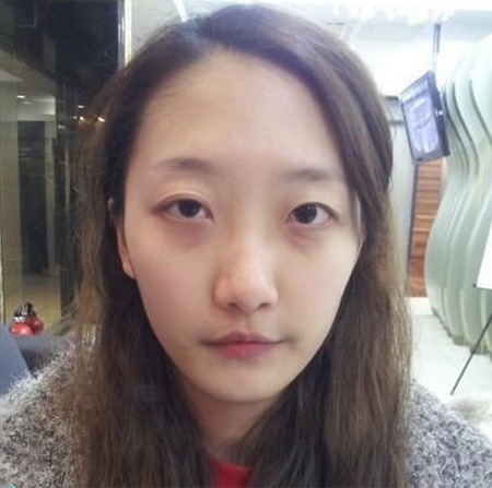 超声波祛眼袋让我的人生如此美丽843 超声波祛眼袋让我的人生如此美丽843