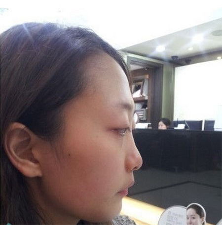 超声波祛眼袋让我的人生如此美丽843 超声波祛眼袋让我的人生如此美丽843