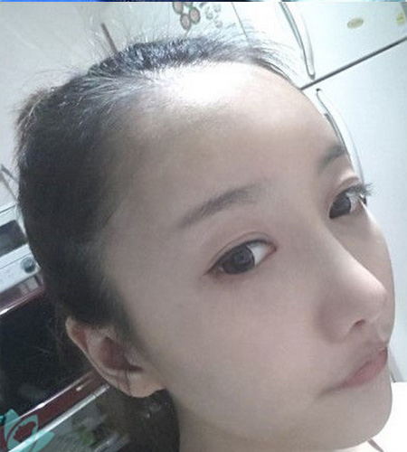 超声波祛眼袋让我的人生如此美丽843 超声波祛眼袋让我的人生如此美丽843