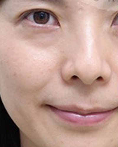 超 声 波去眼袋做年轻漂亮得女人 超 声 波去眼袋做年轻漂亮得女人