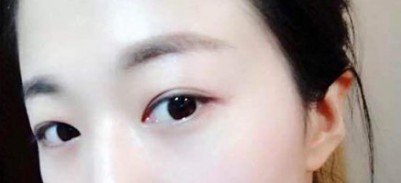 十分方便快捷的去眼袋,超声波去眼袋350 十分方便快捷的去眼袋,超声波去眼袋350