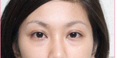 十分方便快捷的去眼袋,超声波去眼袋350 十分方便快捷的去眼袋,超声波去眼袋350