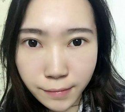 超声波双眼皮,做一个幸福的女人815 超声波双眼皮,做一个幸福的女人815