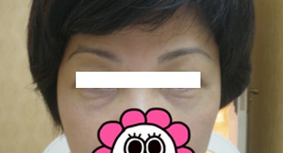去掉眼袋变得年轻漂亮了很多777 去掉眼袋变得年轻漂亮了很多777