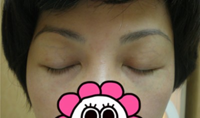 去掉眼袋变得年轻漂亮了很多777 去掉眼袋变得年轻漂亮了很多777