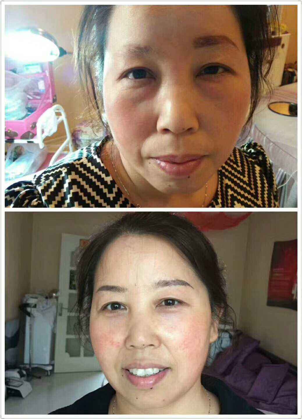 去眼袋手术哪种更好ー些?自然超 声 波去眼袋 去眼袋手术哪种更好ー些?自然超 声 波去眼袋