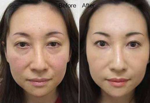 去眼袋手术哪种更好ー些?自然超 声 波去眼袋 去眼袋手术哪种更好ー些?自然超 声 波去眼袋